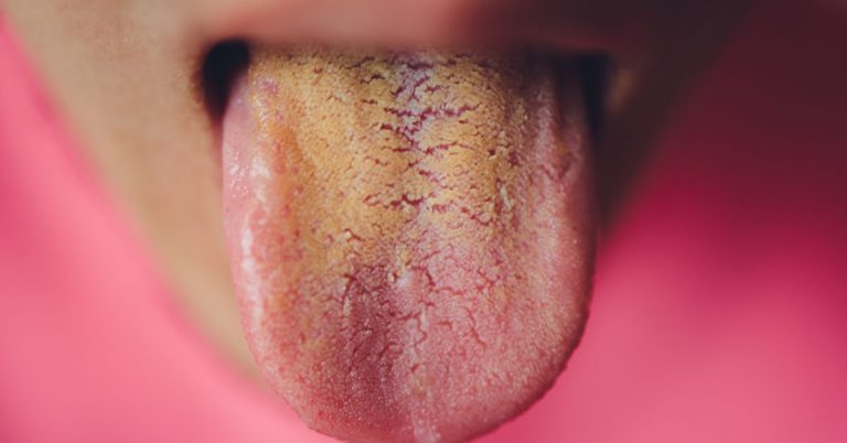 Read more about the article Why Is My Tongue Yellow? 7 Possible Explanations