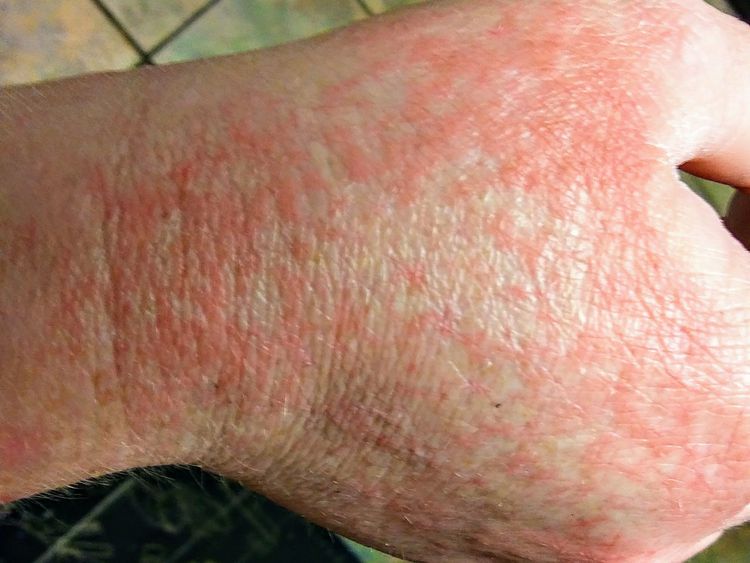 Read more about the article COVID-19 Rash Explained: What You Need to Know
