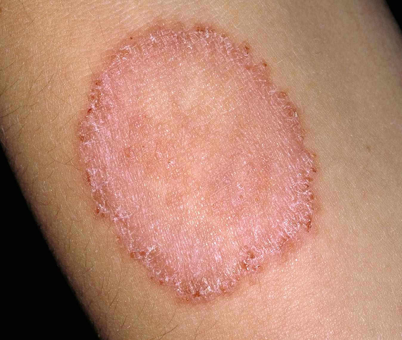 You are currently viewing What is Ringworm and How to Identify It?